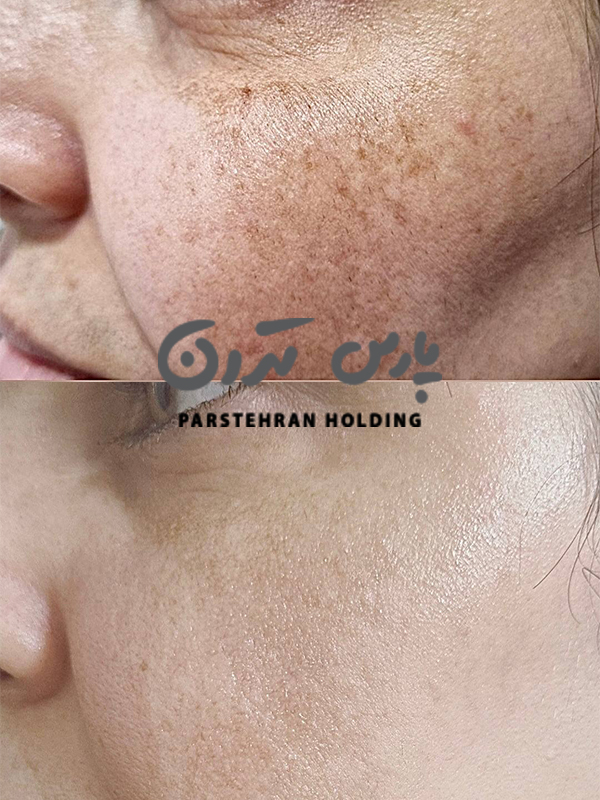 نتیجه قبل و بعد از کیوسوئیچ لک و کک و مک