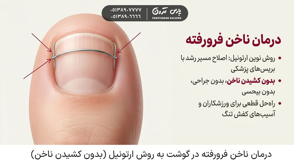 Treatment of ingrown toenails using the Orthonail method without pulling the nail درمان ناخن فرورفته در گوشت به روش ارتونیل (بدون کشیدن ناخن)
