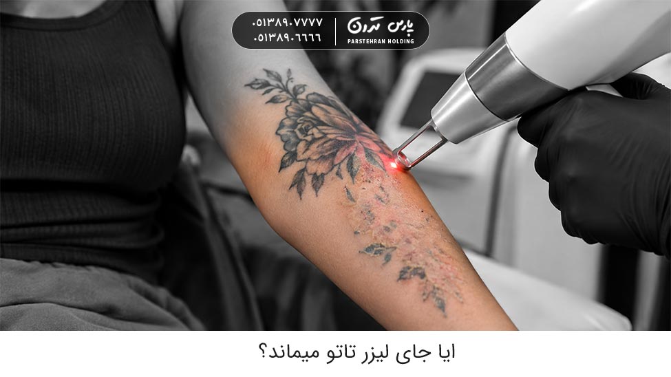 does laser tattoo leave scar ایا جای لیزر تاتو میماند؟