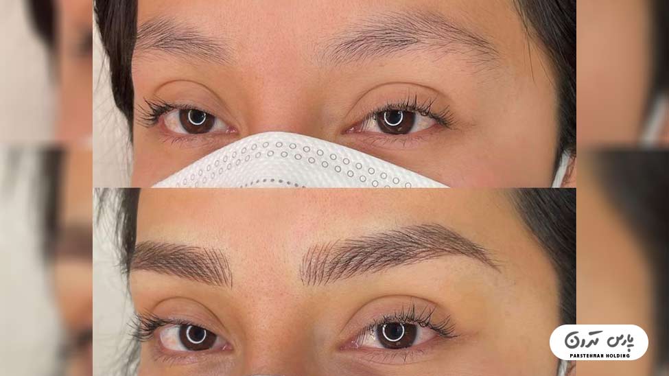 Types of eyebrow fibrosis models14 فیبروز ابرو با خطوط ظریف