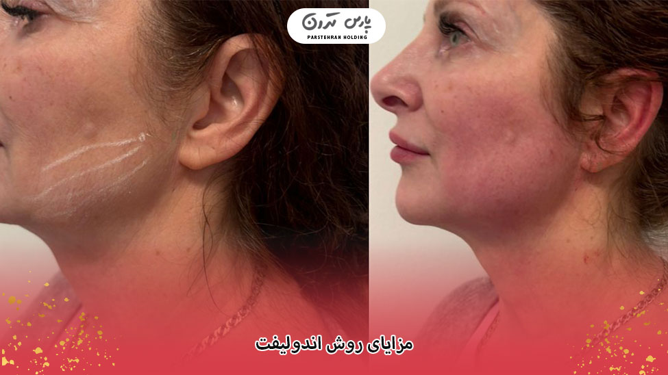 Benefits of the Endolift procedure مزایای روش اندولیفت