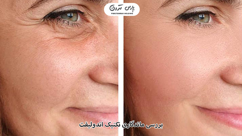 Examining the durability of the endolift technique بررسی ماندگاری تکنیک اندولیفت