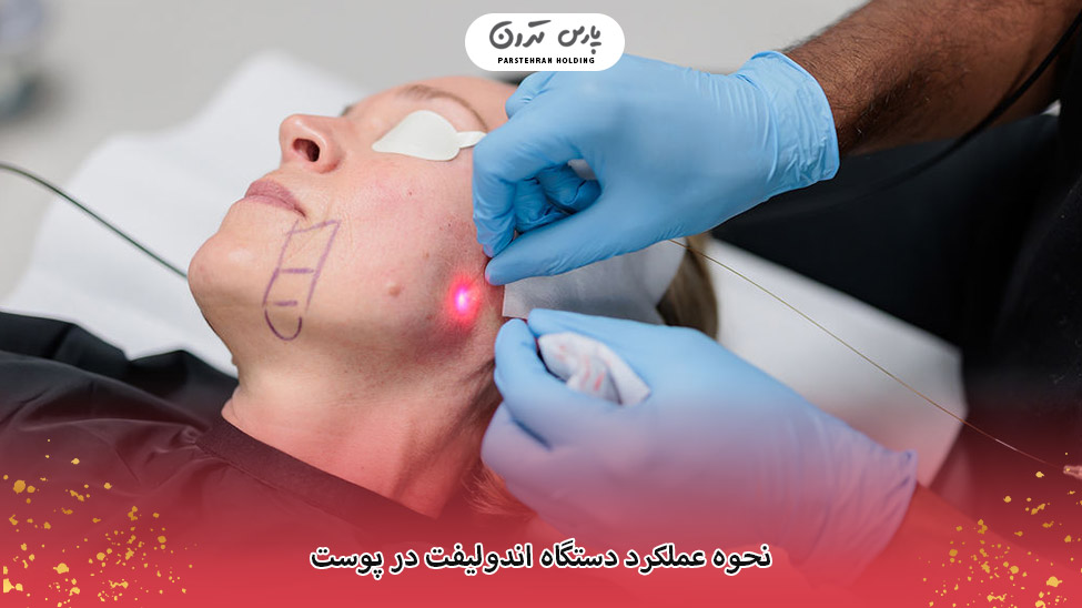 How the Endolift device works on the skin نحوه عملکرد دستگاه اندولیفت در پوست