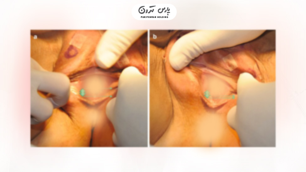 Before and after fat injection into the vaginal area عکس قبل و بعد از تزریق چربی به ناحیه بیکینی