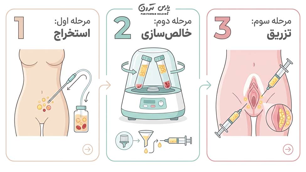 Steps for performing vaginal fat injection مراحل انجام عمل تزریق چربی به واژن چگونه انجام میشود