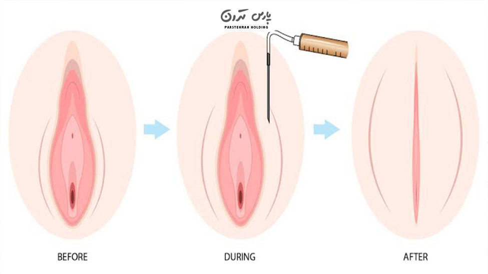Who are good candidates for vaginal fat injections چه کسانی میتوانند تزریق چربی به ناحیه بیکینی انجام دهند