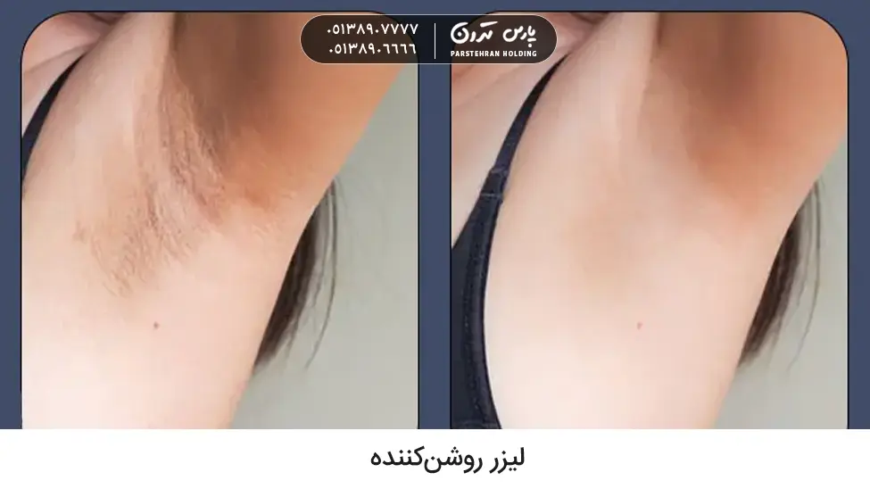 Brightening laser لیزر روشنکننده بهترین روش رفع سیاهی زیر بغل در مدت کوتاه