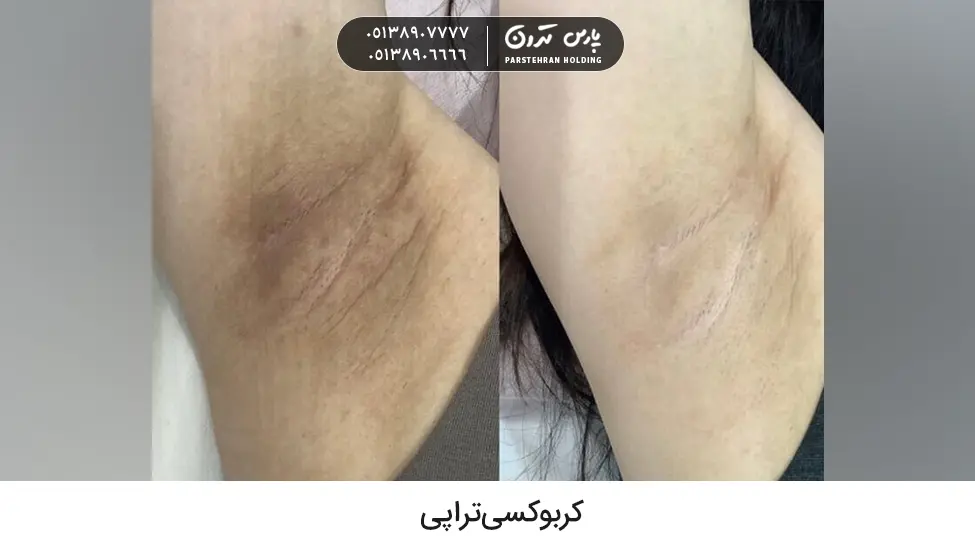 Carboxytherapy to remove dark underarms کربوکسی تراپی رفع سیاهی زیربغل