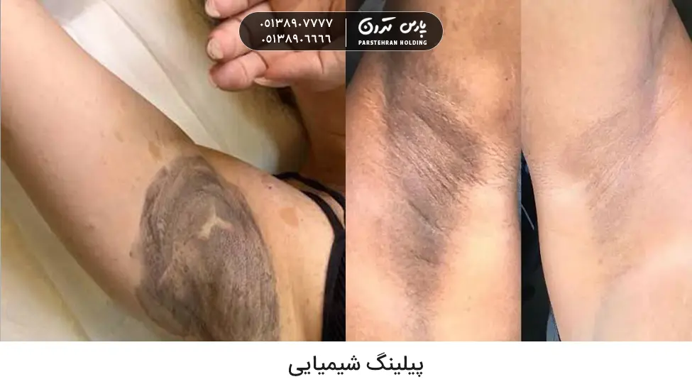 Chemical peeling پیلینگ شیمیایی