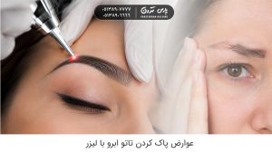 عوارض پاك كردن تاتو ابرو با ليزر