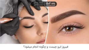 فیبروز ابرو چیست و چگونه انجام میشود