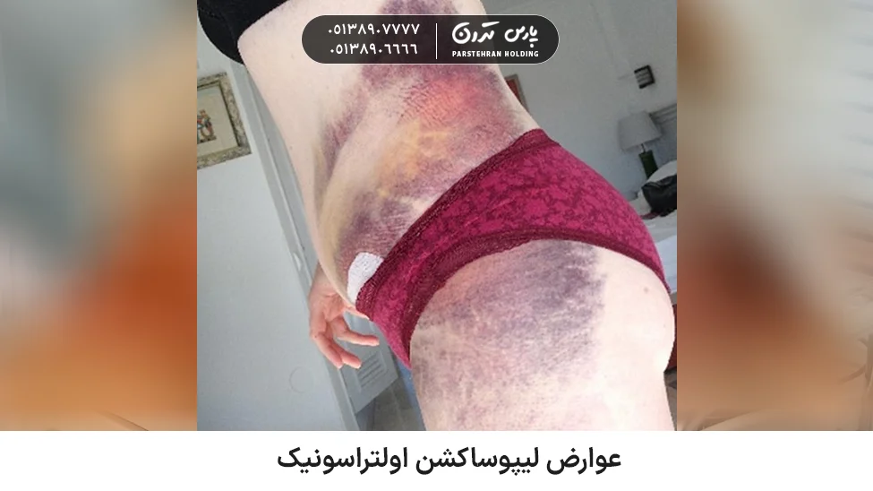 Complications of ultrasonic liposuction عوارض لیپوساکشن اولتراسونیک