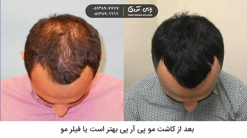 Is PRP better after hair transplantation or hair filler بعد از کاشت مو پی آر پی بهتر است یا فیلر مو