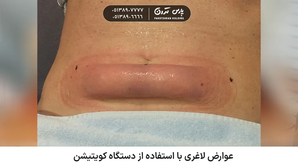 Side effects of losing weight using a cavitation device عوارض لاغری با استفاده از دستگاه کویتیشن