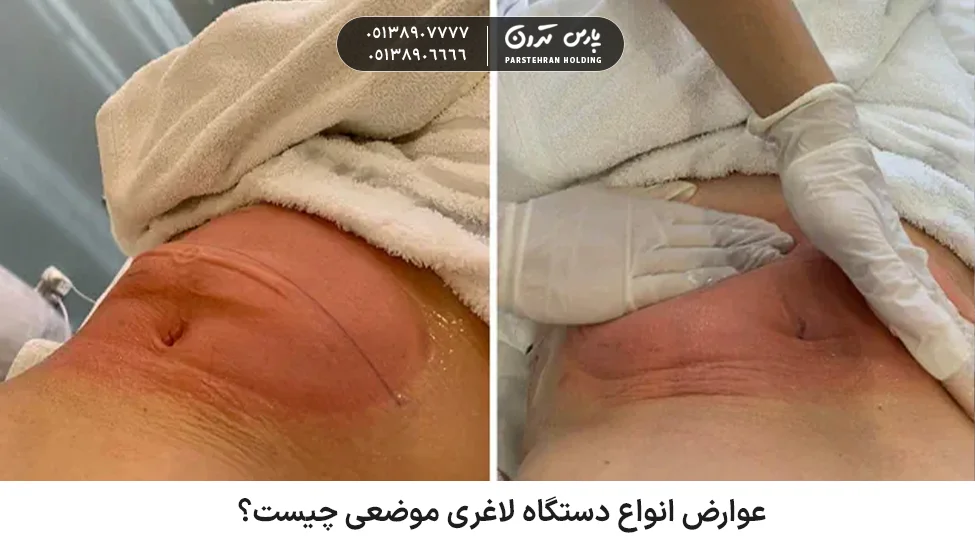 What are the side effects of various types of topical slimming devices عوارض انواع دستگاه لاغری موضعی چیست؟