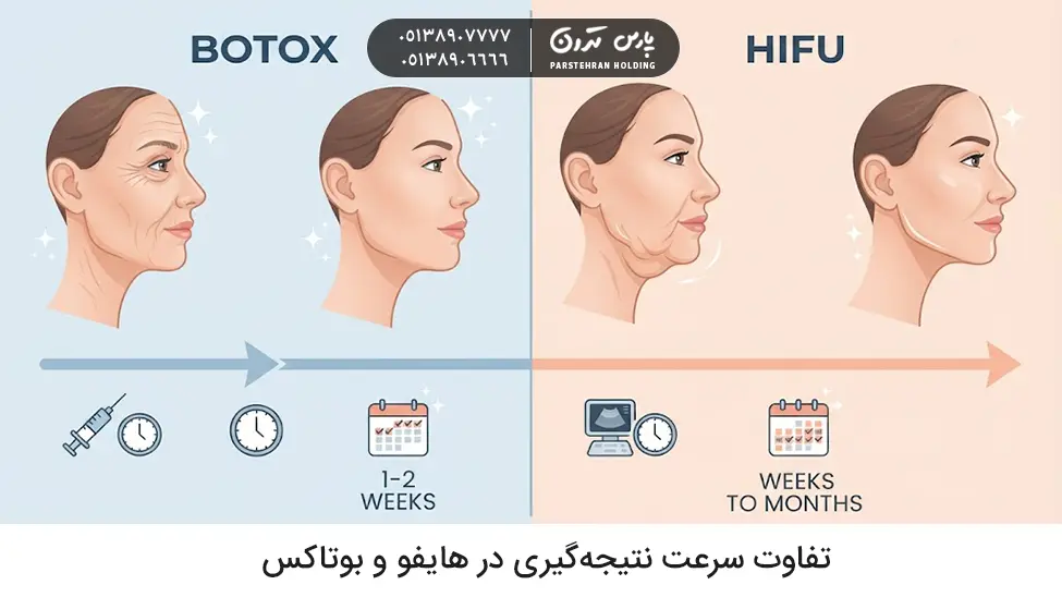 The difference in the speed of results in HIFU and تفاوت سرعت نتیجهگیری در هایفو و بوتاکس