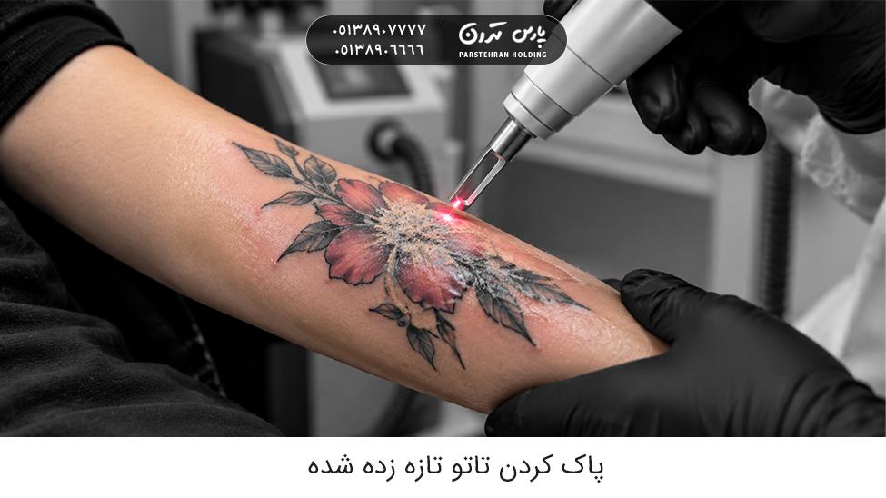 removing a fresh tattoo پاك كردن تاتو تازه زده شده به صورت دائمی